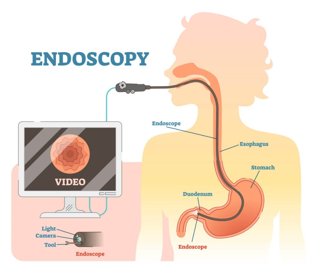 Zánět žaludku - gastroduodenoskopia/endoskopia