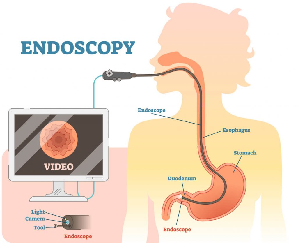 Zápal žalúdka - gastroduodenoskopia/endoskopia