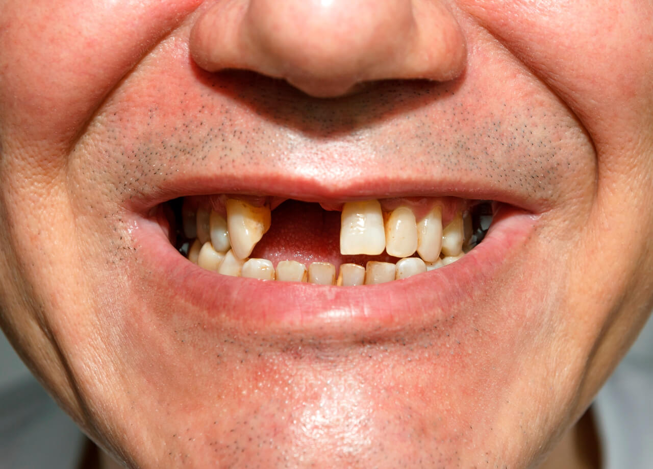 Jak urychlit vypadnutí zubu?