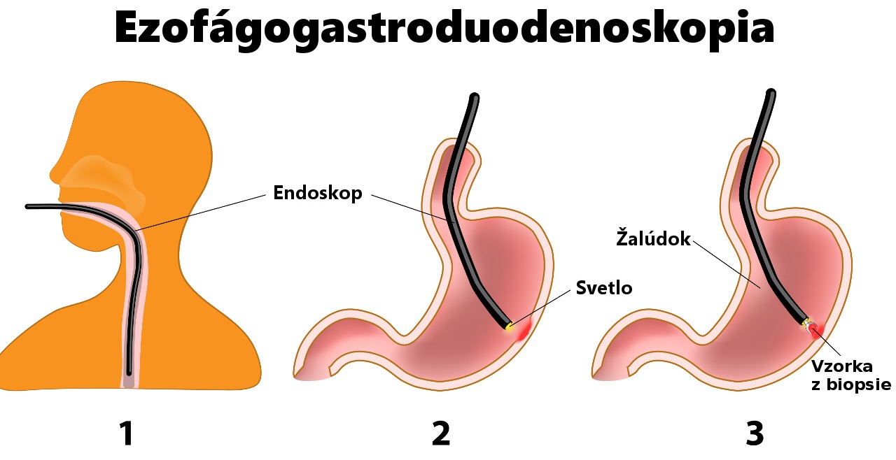 Gastroskopia (Ezofágogastroduodenskopia) je diagnostický postup. Endoskop je dlhá, flexibilná, osvetlená trubica. Endoskop je vedený pacientovými ústami a hrdlom, potom pažerákom, žalúdkom a dvanástnikom.