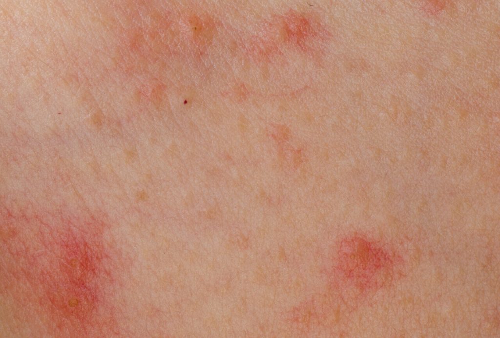 Alergická dermatitida - vyrážka na kůži