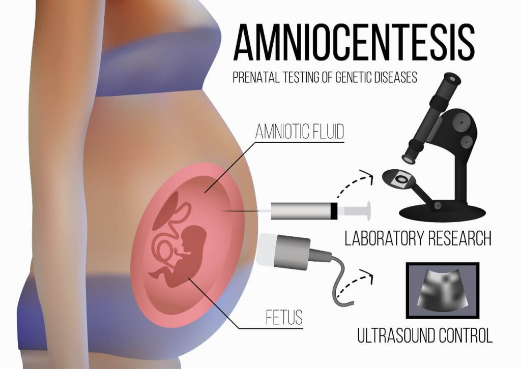 Amniocentéza - vyšetření v těhotenství
