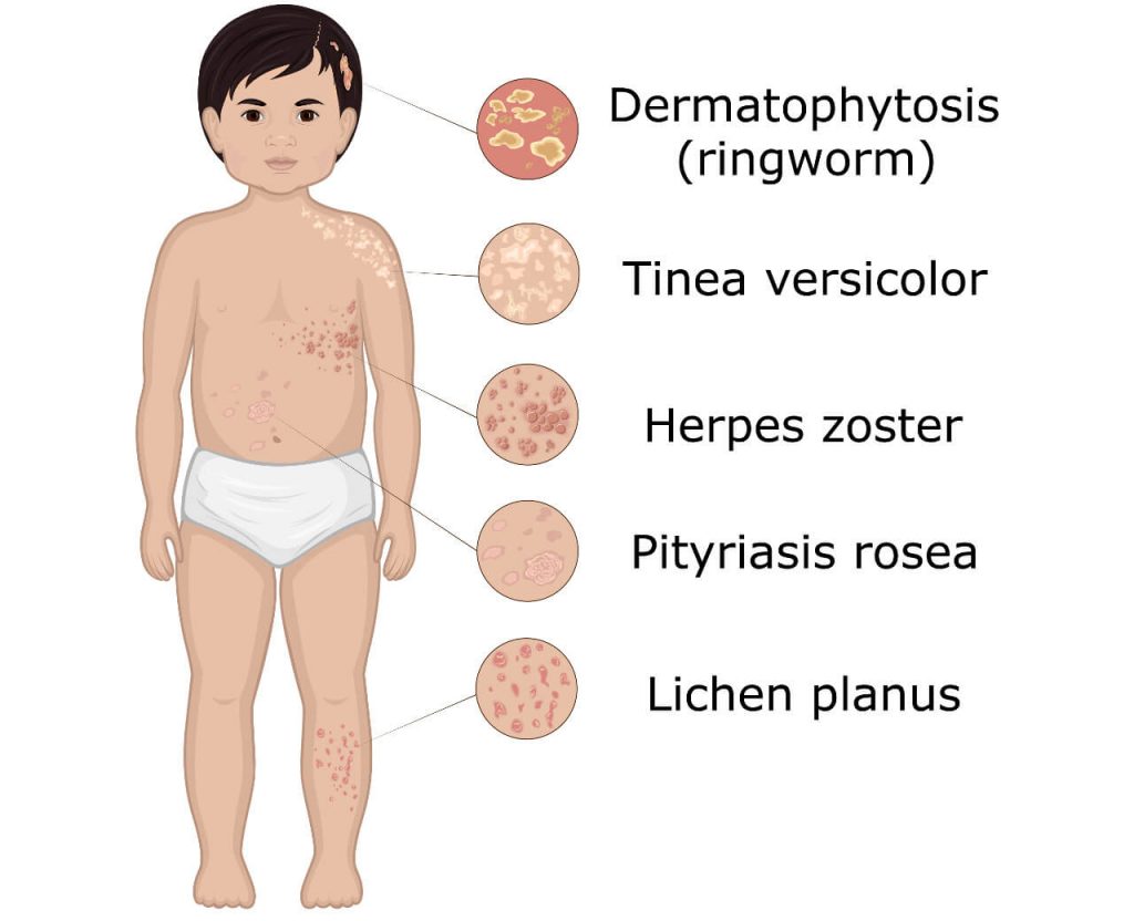 Päť typov kožných vyrážok na tele malého dieťaťa