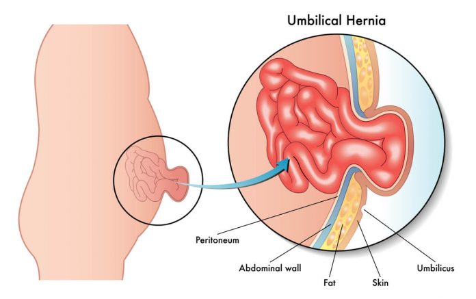 Pruh (hernia) Pruh (hernia)