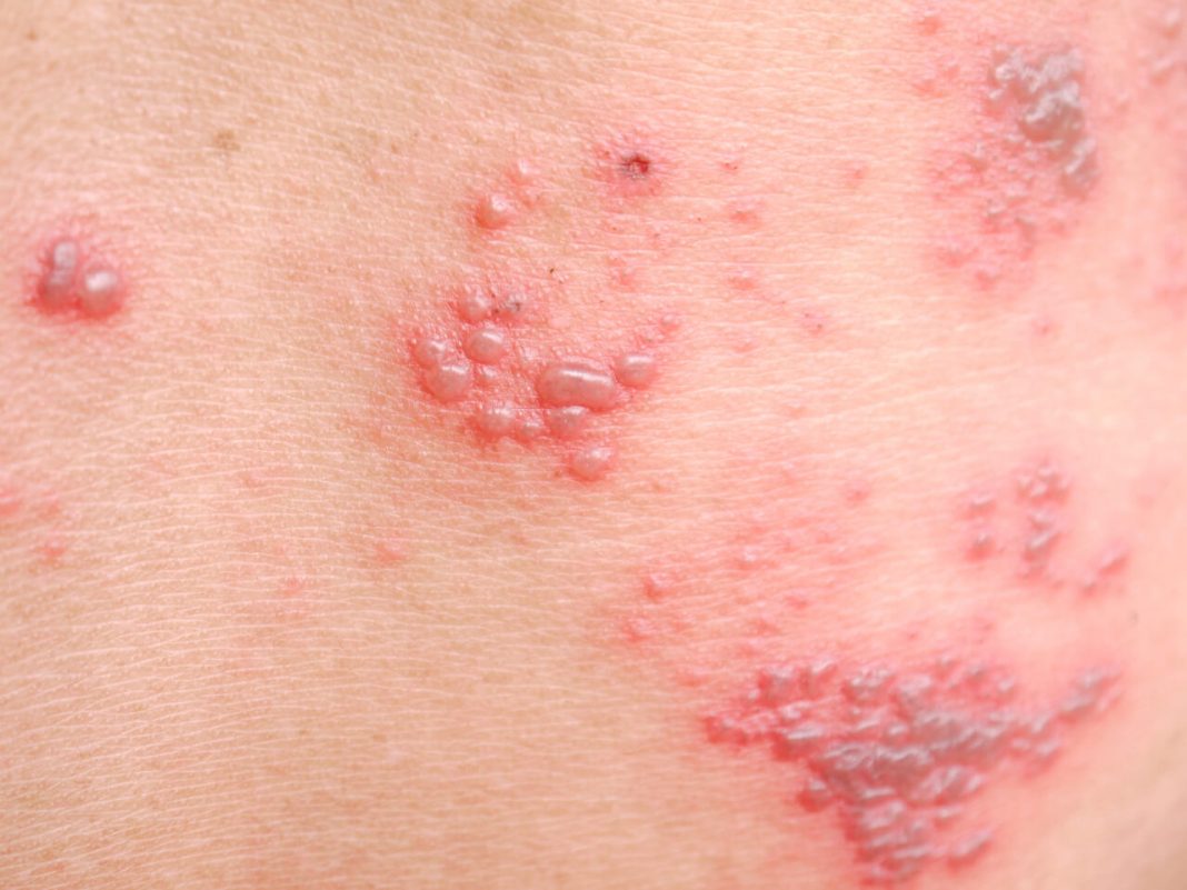 Dermatitis Herpetiformis Images Symptoms And Pictures My Xxx Hot Girl