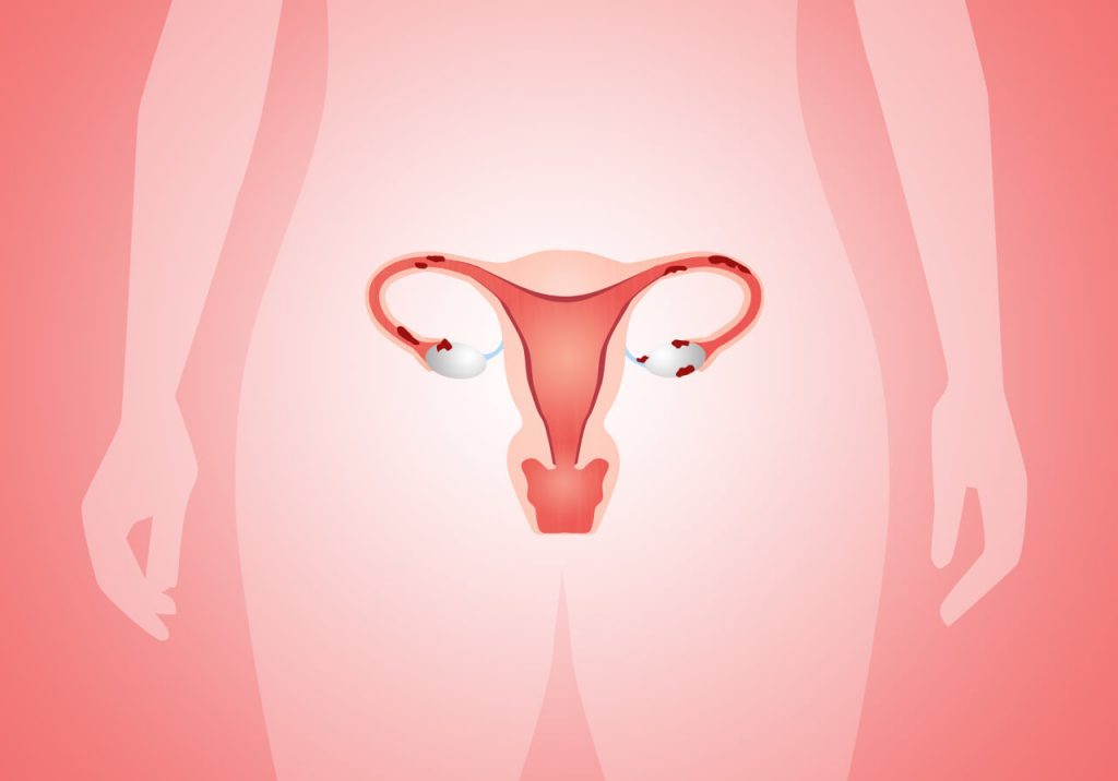 Endometrióza, menštruácia