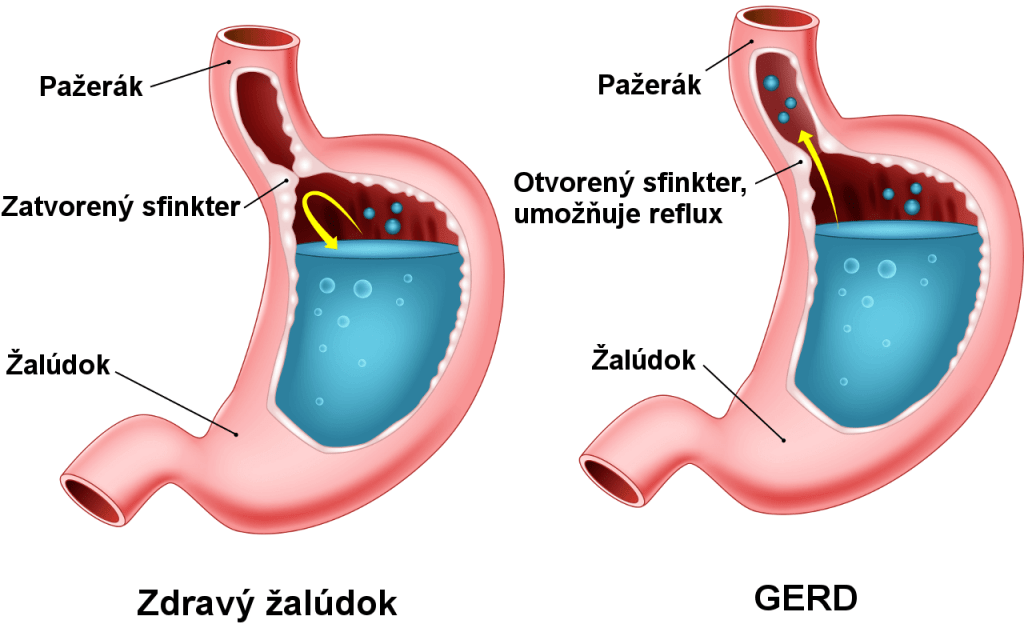 Reflux, gastroezofágová refluxová choroba (GERD)