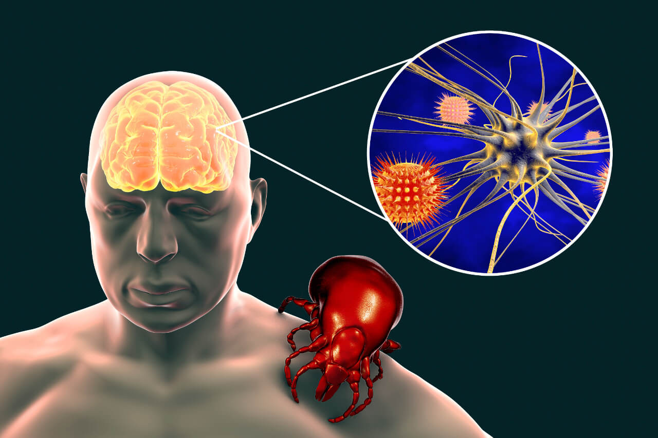 Encefalitída spôsobená kliešťom - neuróny sú infikované vírusmi
