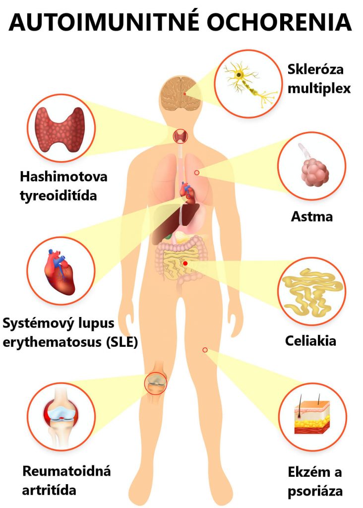 Autoimunitní onemocnění (seznam, infografika) - skleróza multiplex, Hashimotova tyroiditida, astma, celiakie, systémový lupus erythematodes, revmatoidní artritida, ekzém a psoriáza