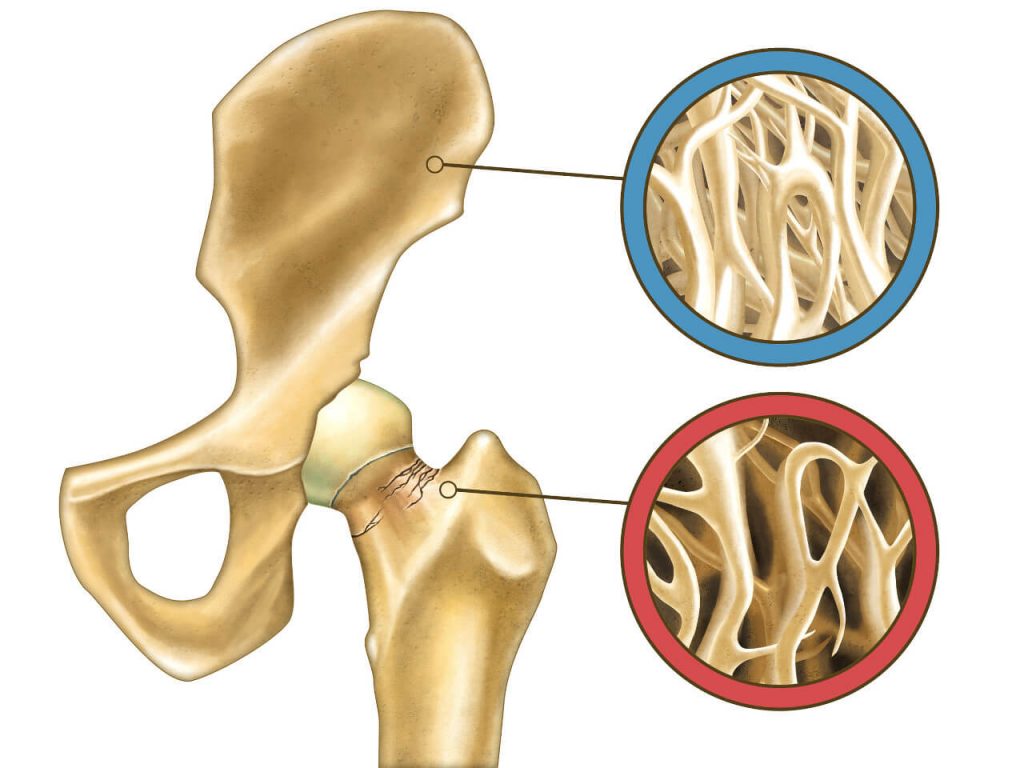 Osteoporóza / osteopenie a zdravá kost (srovnání)