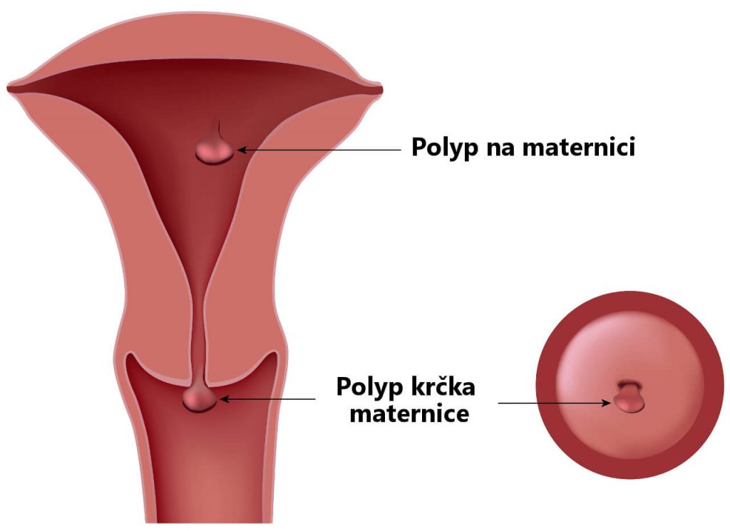Polypy na maternici a polyp krčka maternice