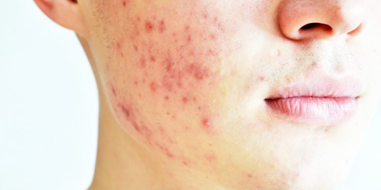Akné na tvári