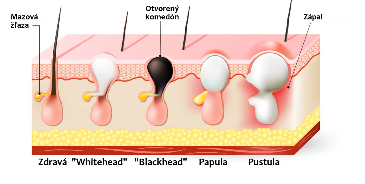 Pimples On Asscrack