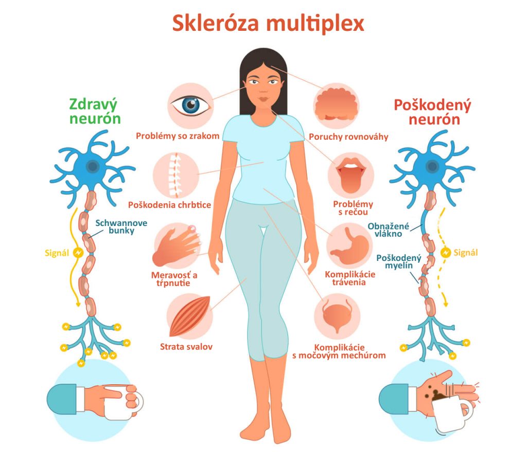 Skleróza multiplex + príznaky
