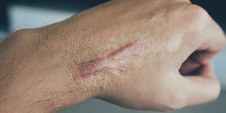 Jazva na ruke - Pomôže krém na jazvy?