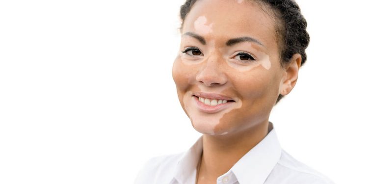 Vitiligo - kožná choroba + jej liečba