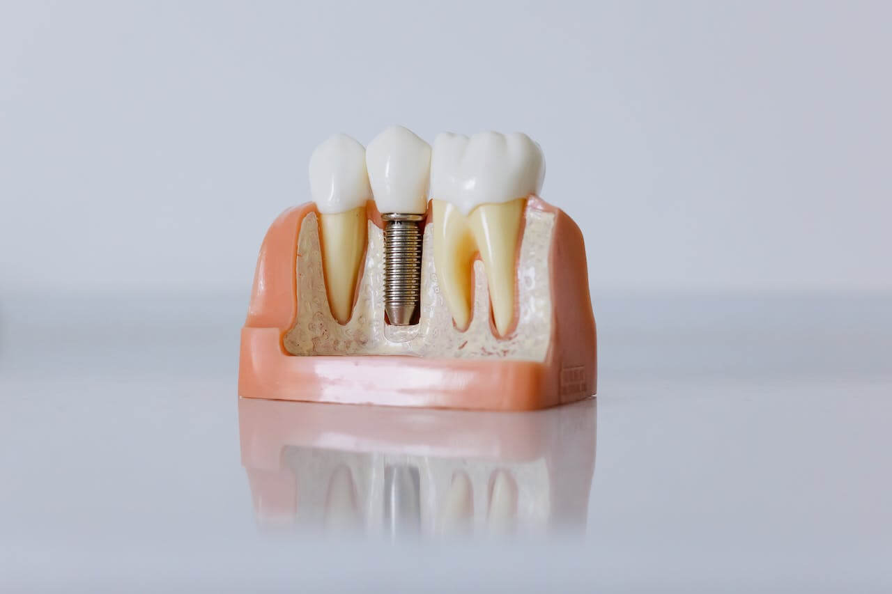 Zubné implantaty